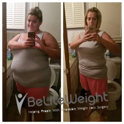 Weight Loss Surgery Before And After